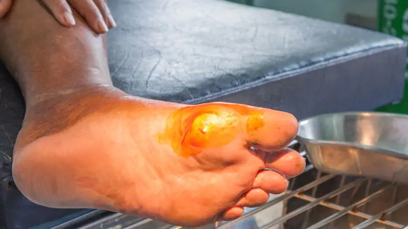 Picha ya mguu kuonesha vidonda vya kisukari