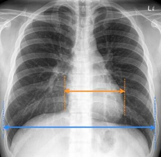Picha ya X-Ray ya kifua- moja ya vipimo muhimu kwa mgonjwa wa presha