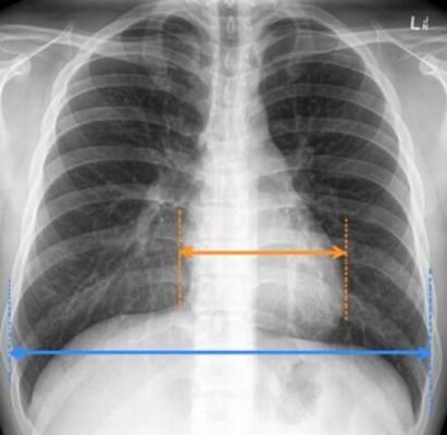 Picha ya X-Ray ya kifua- moja ya vipimo muhimu kwa mgonjwa wa presha